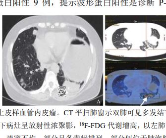 肺上皮样血管内皮瘤的CT及18F-FDG PET/CT表现