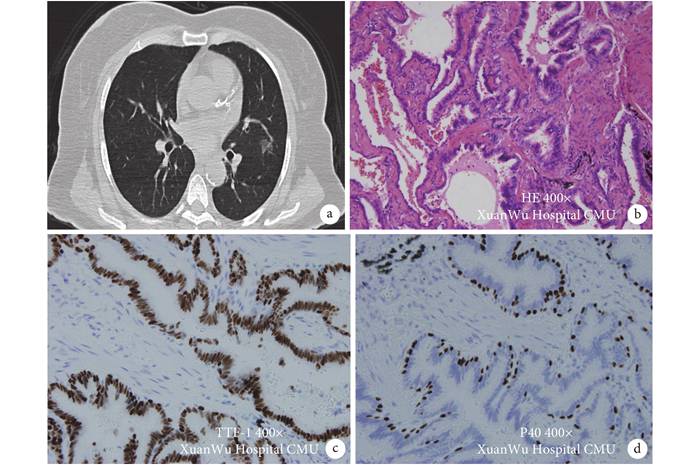 细支气管腺瘤的影像学特征及术后病理分析