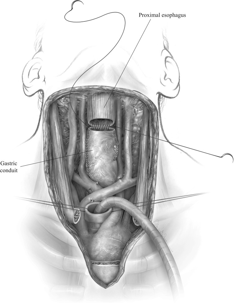 Mediastinal Tracheostomy With Vessel Transposition and Minimally Invasive Transhiatal Esophagectomy