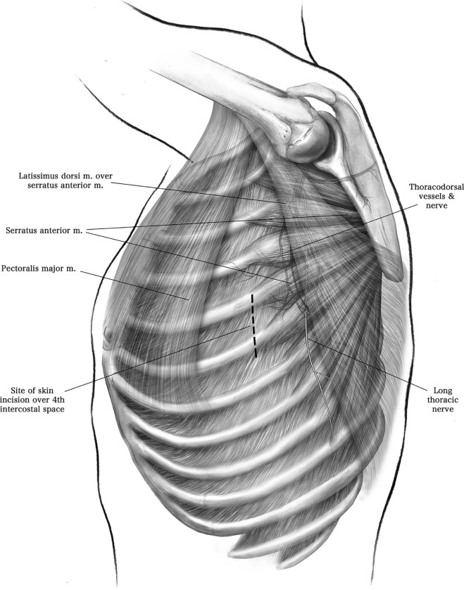 Muscle-sparing Axillary Thoracotomy保留肌肉的腋下开胸术