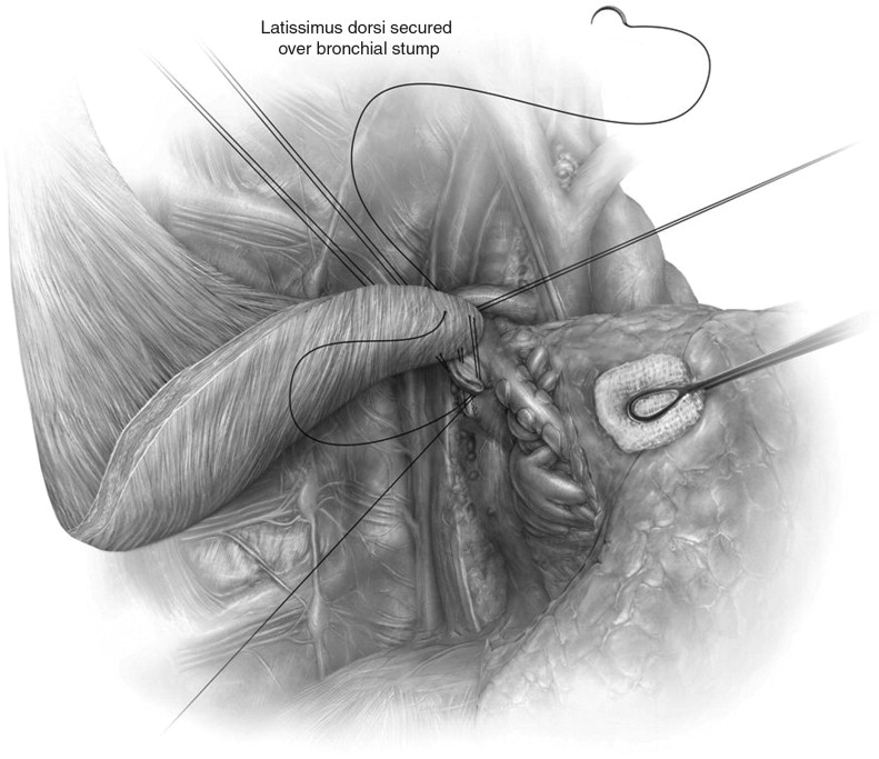 Technique of Muscle Flap Harvest for Intrathoracic Use