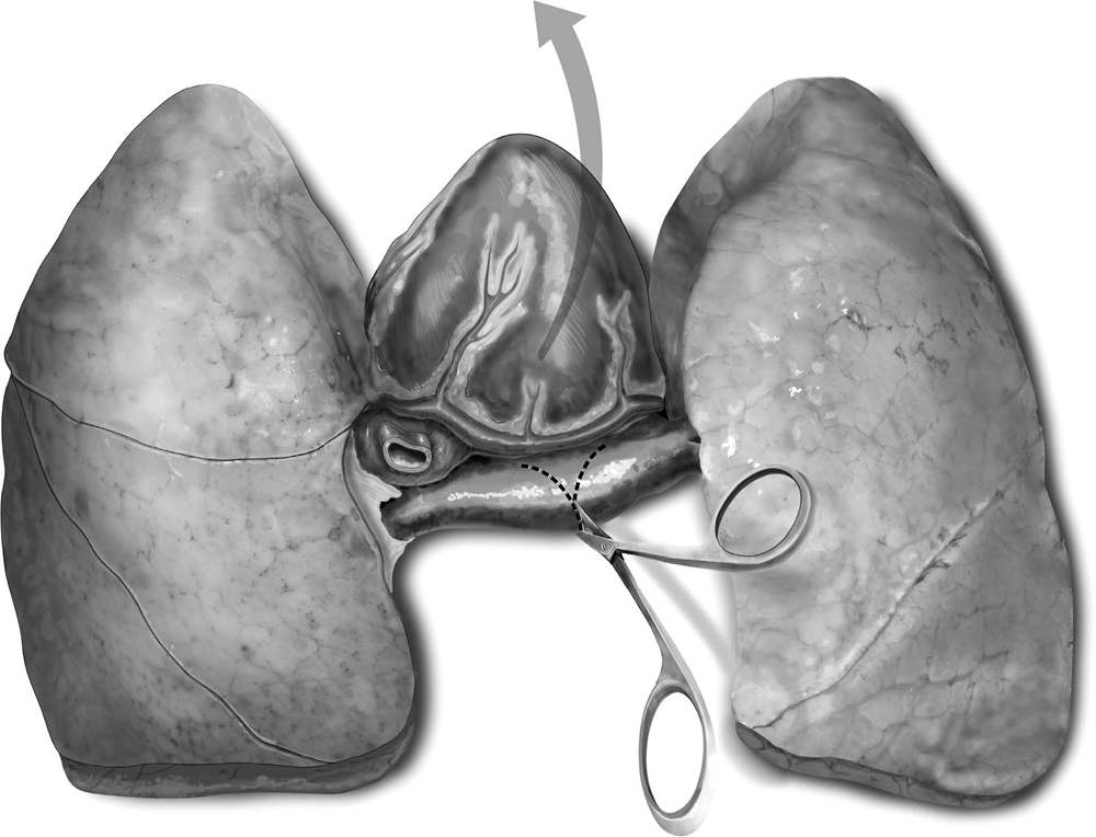 Techniques for Lung Procurement for Transplantation Following Donation After Circulatory Death