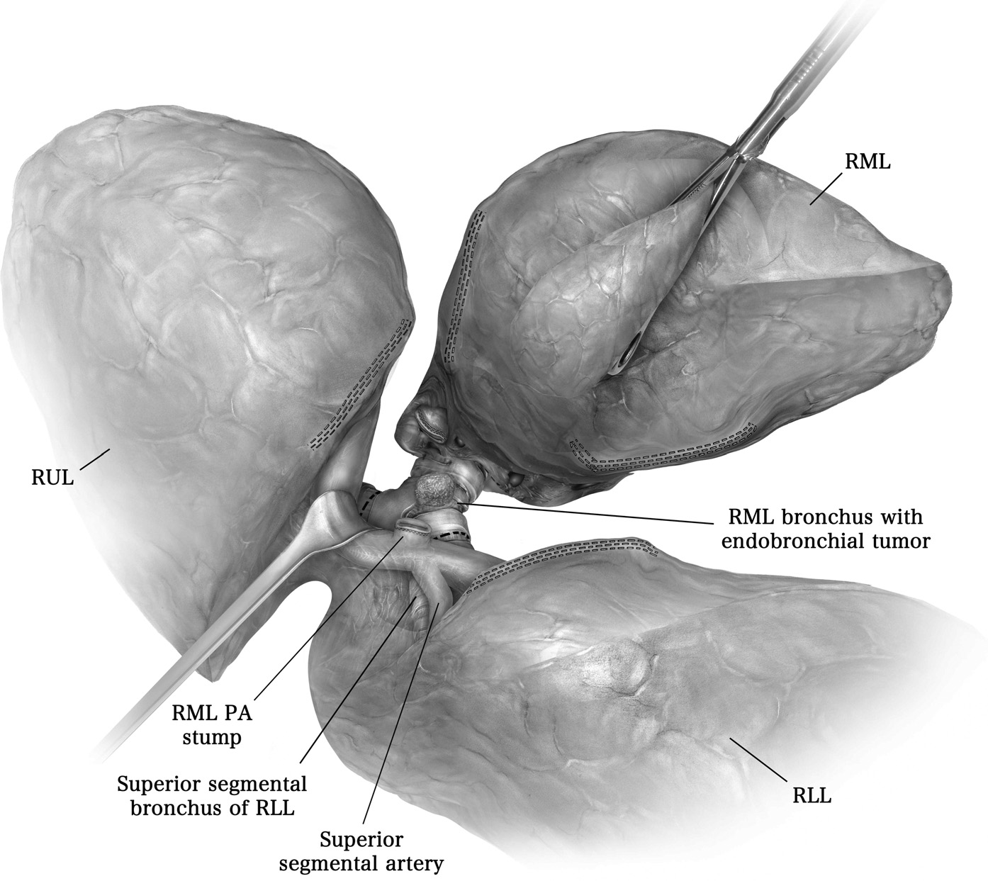 Parenchymal-Sparing Lung Resections:<br>Technique of Sleeve Resections