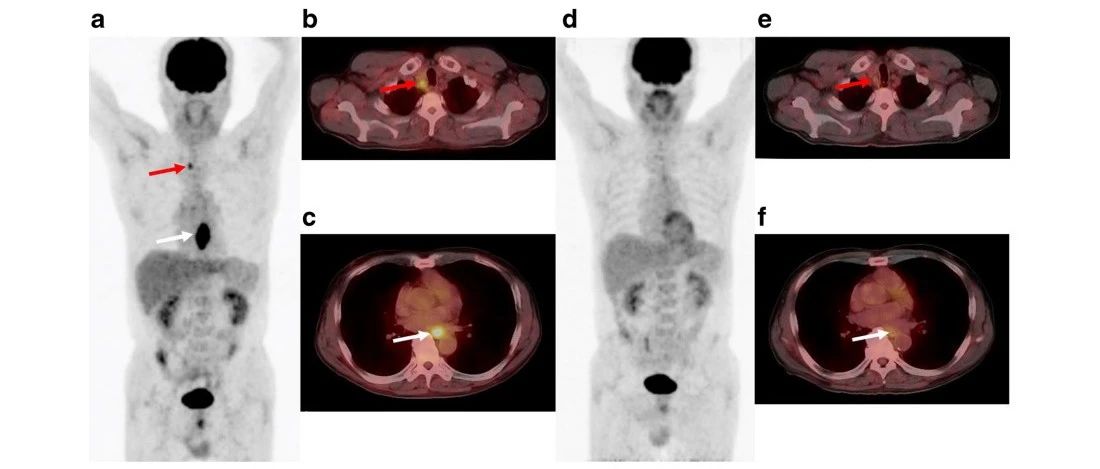 使用PERCIST预测食管鳞状细胞癌患者新辅助化疗的肿瘤反应和预后：一项日本的多中心研究